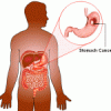 stomach-cancer1-150x150